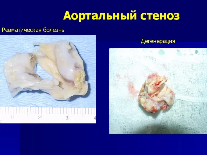 Аортальный стеноз Ревматическая болезнь Дегенерация