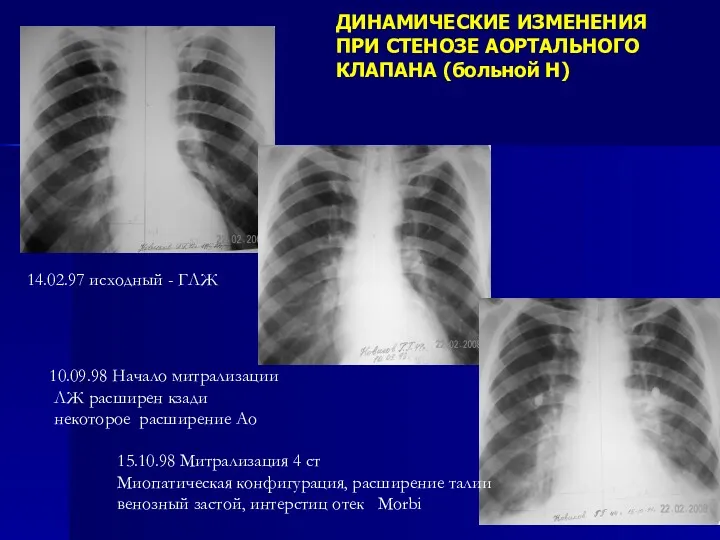 ДИНАМИЧЕСКИЕ ИЗМЕНЕНИЯ ПРИ СТЕНОЗЕ АОРТАЛЬНОГО КЛАПАНА (больной Н) 10.09.98 Начало