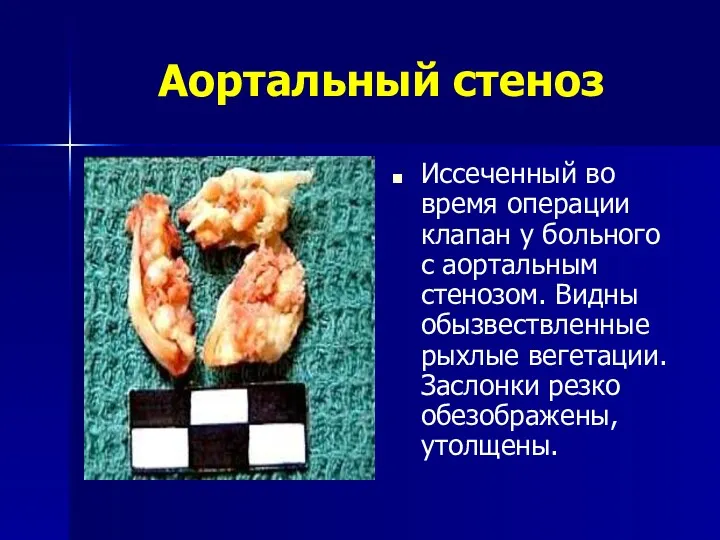 Аортальный стеноз Иссеченный во время операции клапан у больного с