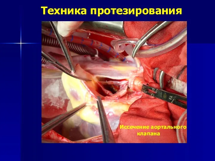 Техника протезирования Иссечение аортального клапана