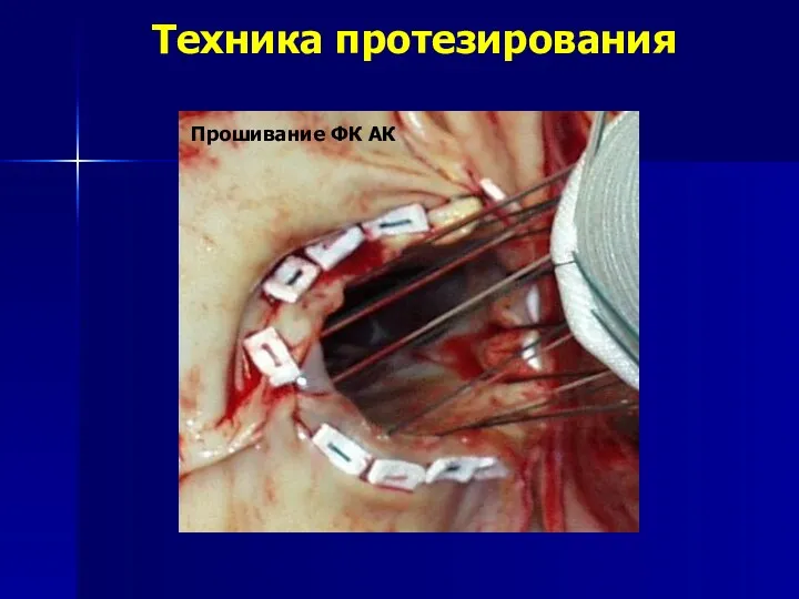 Техника протезирования Прошивание ФК АК