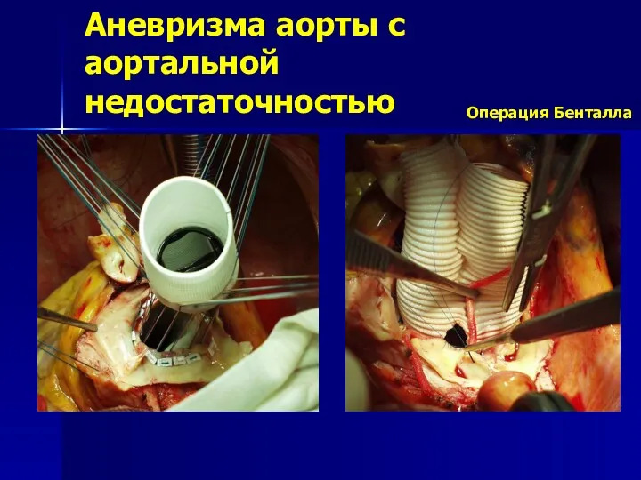 Аневризма аорты с аортальной недостаточностью Операция Бенталла