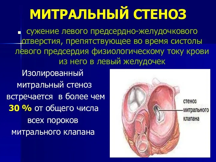 МИТРАЛЬНЫЙ СТЕНОЗ сужение левого предсердно-желудочкового отверстия, препятствующее во время систолы