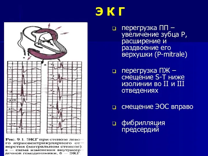 Э К Г перегрузка ПП – увеличение зубца Р, расширение