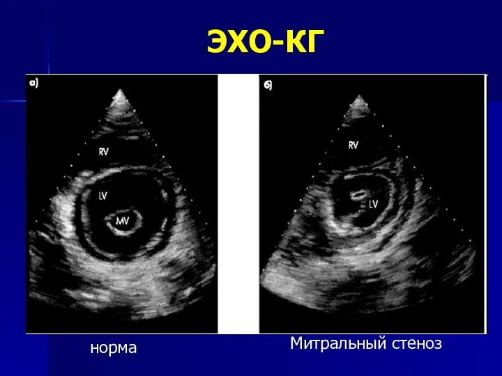 ЭХО-КГ норма Митральный стеноз