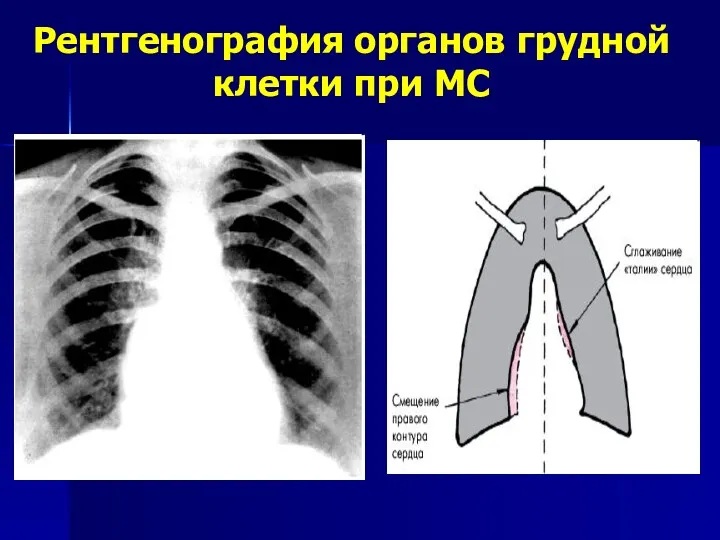 Рентгенография органов грудной клетки при МС