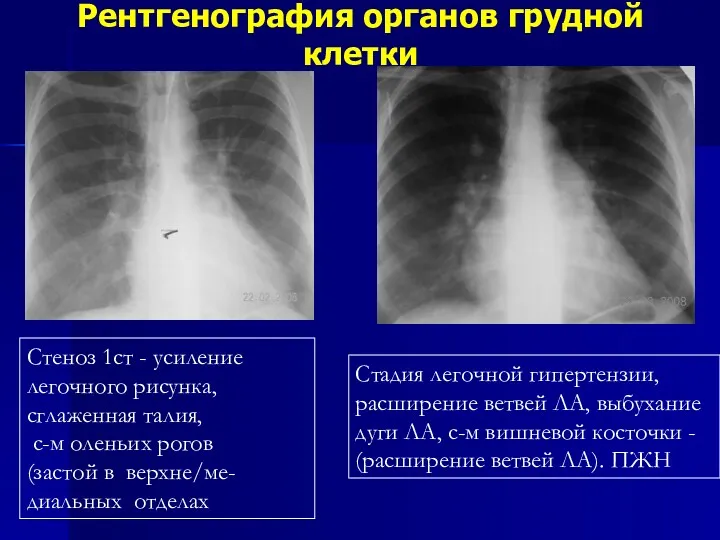 Рентгенография органов грудной клетки Стеноз 1ст - усиление легочного рисунка,