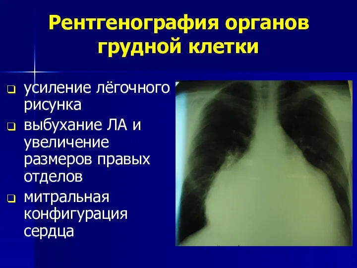 Рентгенография органов грудной клетки усиление лёгочного рисунка выбухание ЛА и