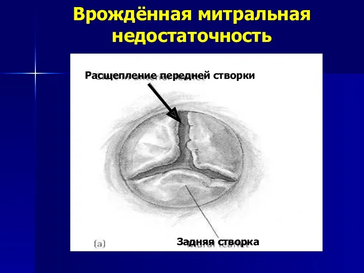 Врождённая митральная недостаточность Задняя створка Расщепление передней створки