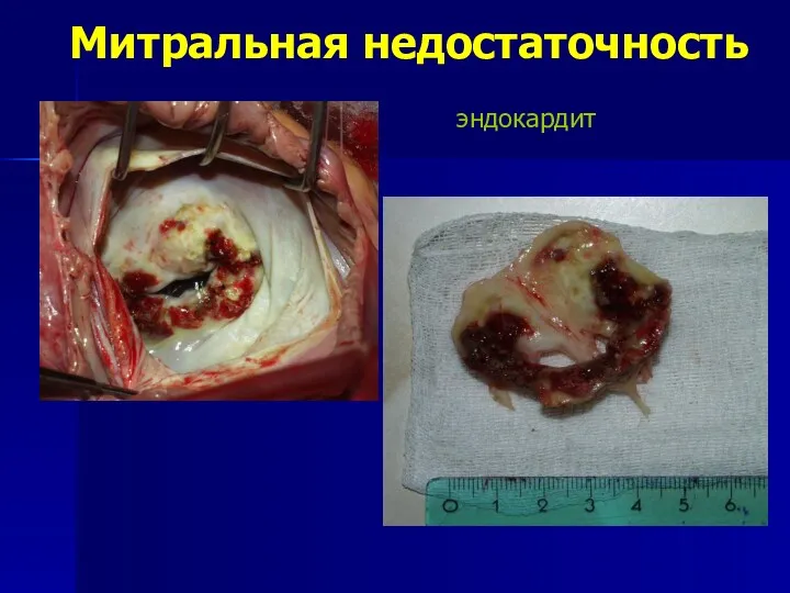 Митральная недостаточность эндокардит