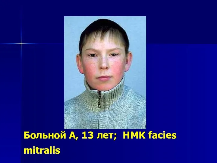 Больной А, 13 лет; НМК fаcies mitralis