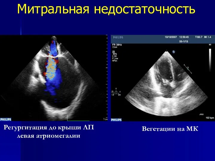 Митральная недостаточность Регургитация до крыши ЛП левая атриомегалии Вегетации на МК