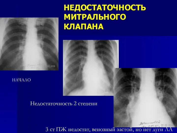 НЕДОСТАТОЧНОСТЬ МИТРАЛЬНОГО КЛАПАНА 3 ст ПЖ недостат, венозный застой, но