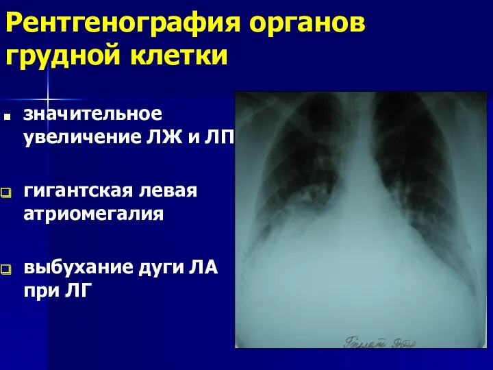 Рентгенография органов грудной клетки значительное увеличение ЛЖ и ЛП гигантская