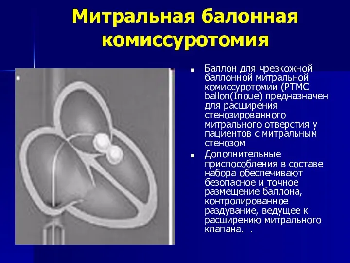 Митральная балонная комиссуротомия Баллон для чрезкожной баллонной митральной комиссуротомии (PTMC