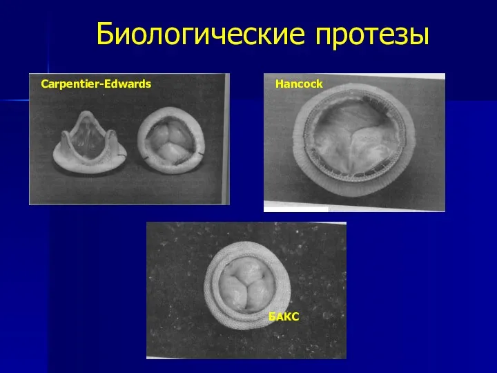 Биологические протезы Carpentier-Edwards Hancock БАКС