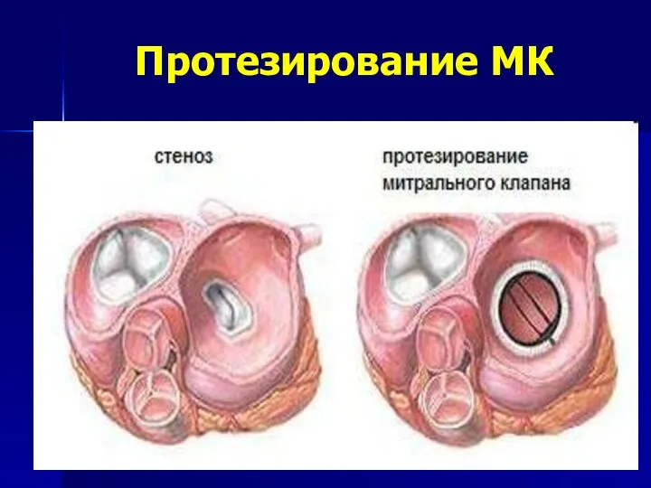 Протезирование МК