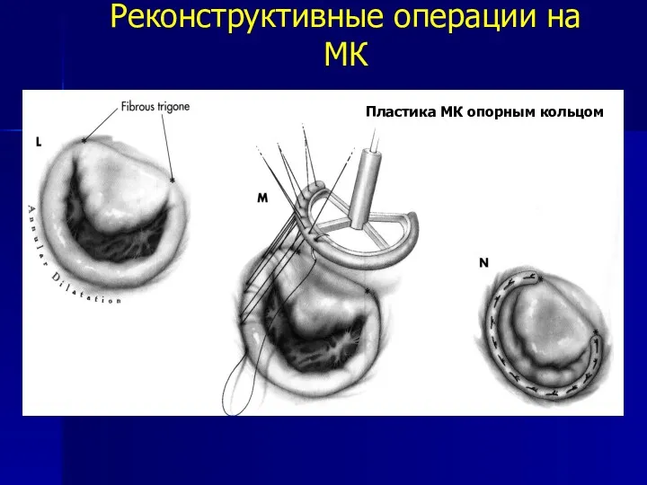 Реконструктивные операции на МК Пластика МК опорным кольцом