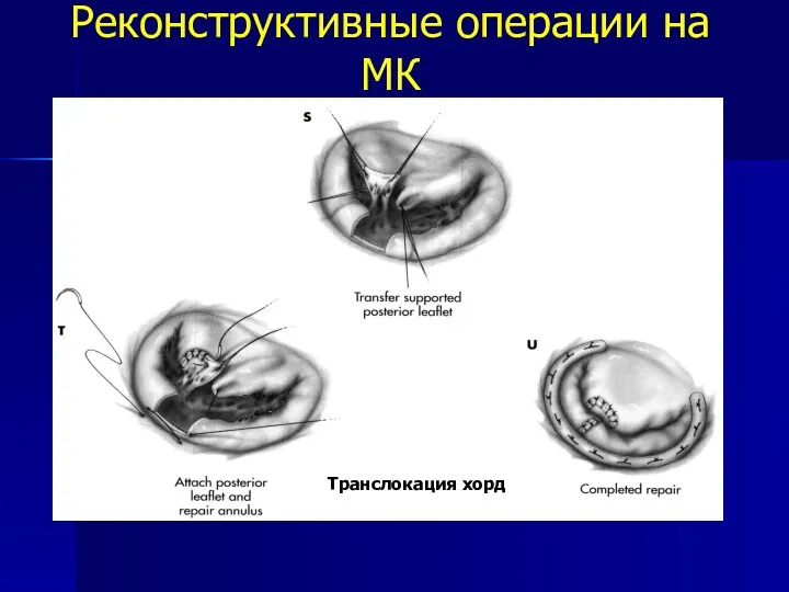 Реконструктивные операции на МК Транслокация хорд Транслокация хорд