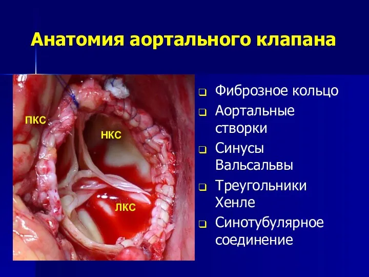 Анатомия аортального клапана Фиброзное кольцо Аортальные створки Синусы Вальсальвы Треугольники Хенле Синотубулярное соединение НКС ПКС ЛКС