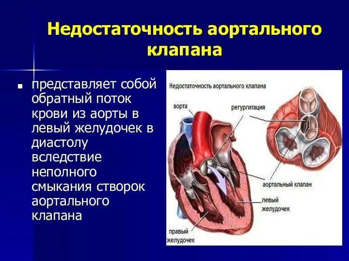 Недостаточность аортального клапана представляет собой обратный поток крови из аорты