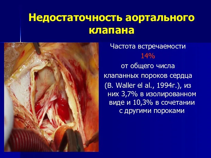 Недостаточность аортального клапана Частота встречаемости 14% от общего числа клапанных