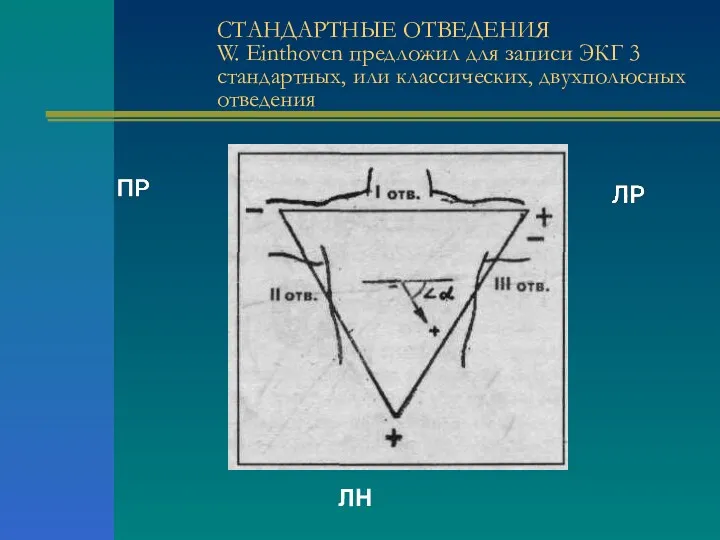 СТАНДАРТНЫЕ ОТВЕДЕНИЯ W. Einthovcn предложил для записи ЭКГ 3 стандартных, или классических, двухполюсных отведения ЛН