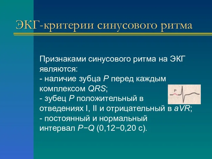 ЭКГ-критерии синусового ритма Признаками синусового ритма на ЭКГ являются: -