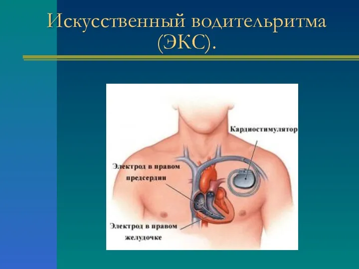 Искусственный водительритма (ЭКС).