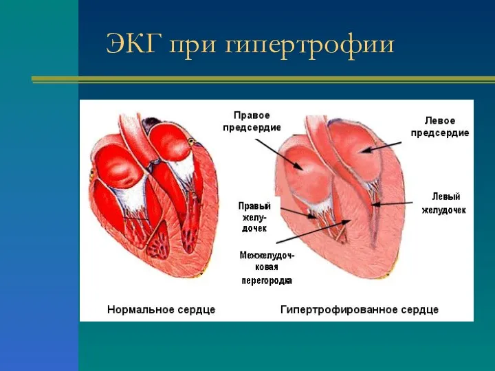 ЭКГ при гипертрофии