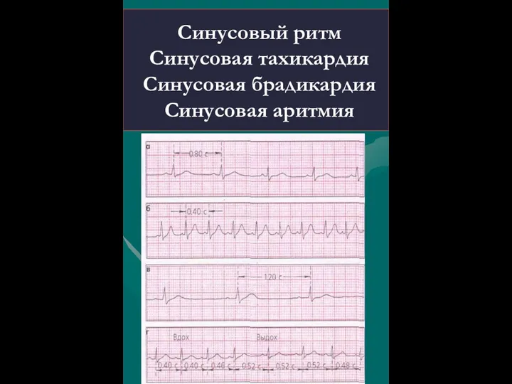 Синусовый ритм Синусовая тахикардия Синусовая брадикардия Синусовая аритмия