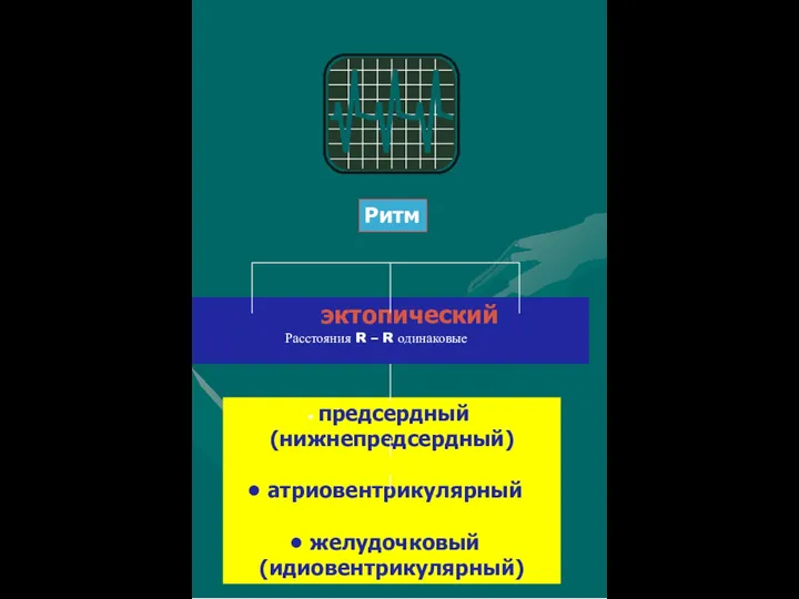 Ритм эктопический Расстояния R – R одинаковые предсердный (нижнепредсердный) атриовентрикулярный желудочковый (идиовентрикулярный)