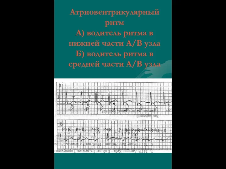 Атриовентрикулярный ритм А) водитель ритма в нижней части А/В узла