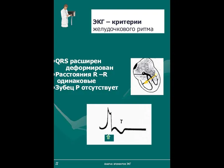 ЭКГ – критерии желудочкового ритма QRS расширен деформирован Расстояния R