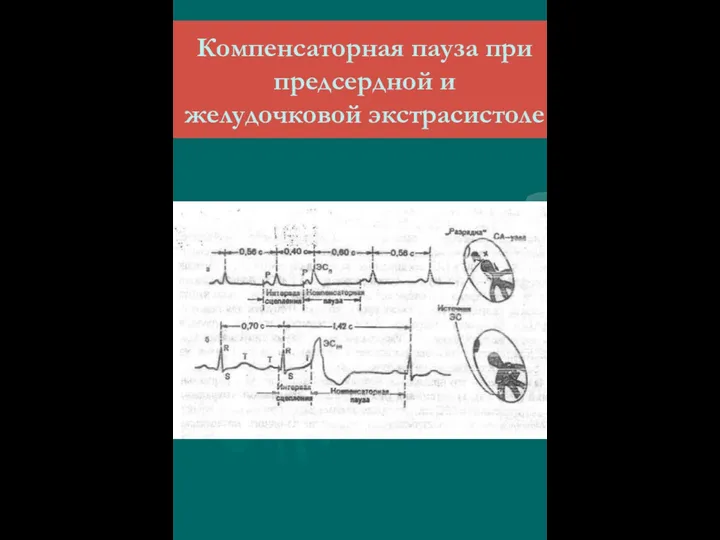 Компенсаторная пауза при предсердной и желудочковой экстрасистоле