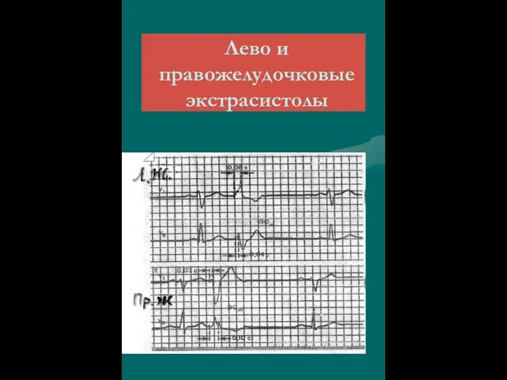 Лево и правожелудочковые экстрасистолы