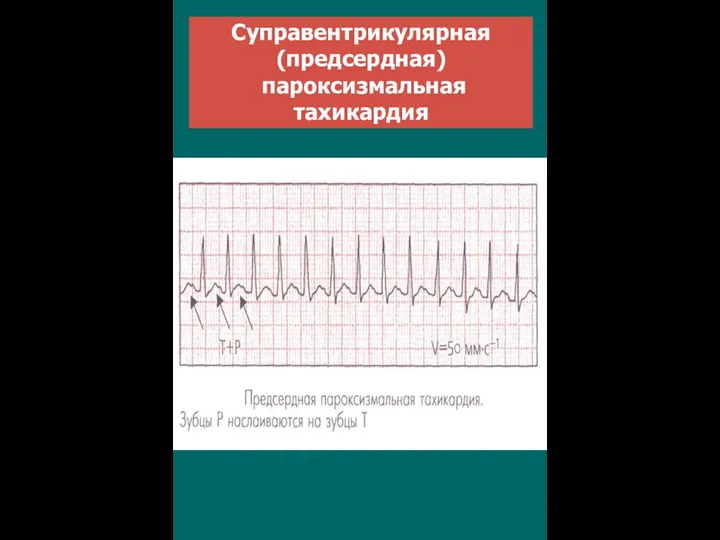 Суправентрикулярная (предсердная) пароксизмальная тахикардия