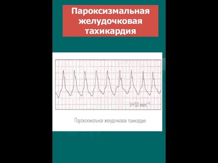 Пароксизмальная желудочковая тахикардия