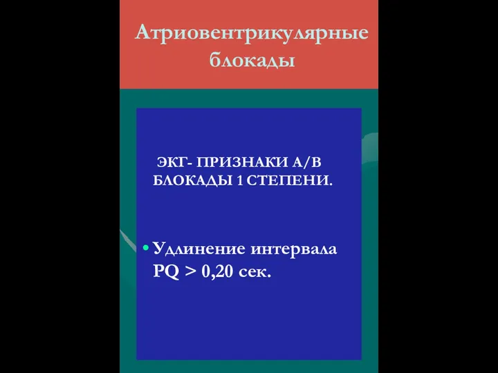 Атриовентрикулярные блокады ЭКГ- ПРИЗНАКИ А/В БЛОКАДЫ 1 СТЕПЕНИ. Удлинение интервала РQ > 0,20 сек.