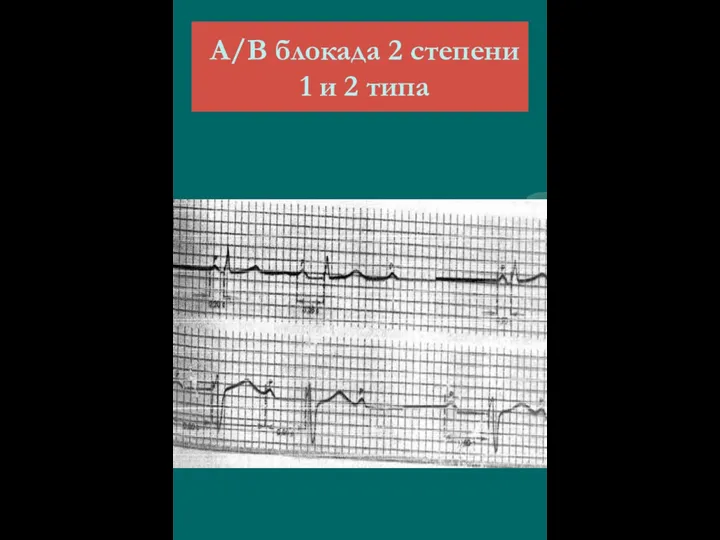 А/В блокада 2 степени 1 и 2 типа