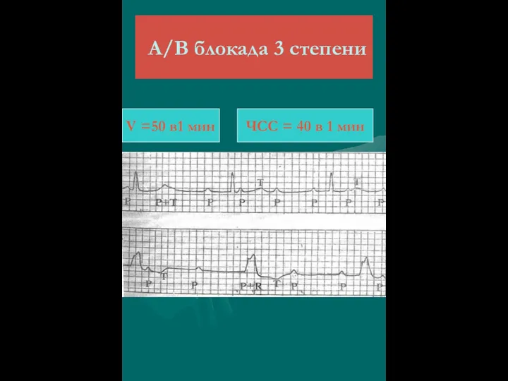 А/В блокада 3 степени V =50 в1 мин ЧСС = 40 в 1 мин