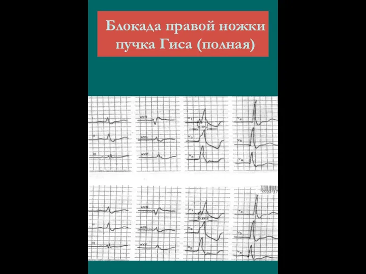 Блокада правой ножки пучка Гиса (полная)