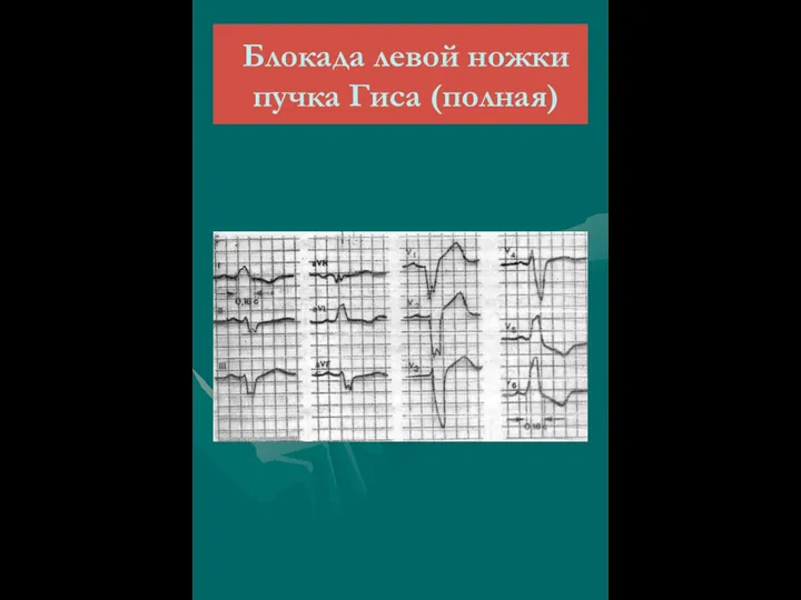 Блокада левой ножки пучка Гиса (полная)