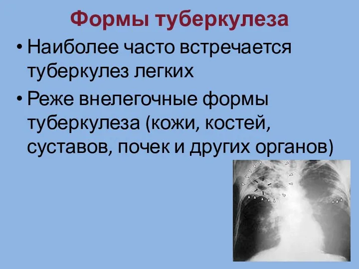 Формы туберкулеза Наиболее часто встречается туберкулез легких Реже внелегочные формы туберкулеза (кожи, костей,