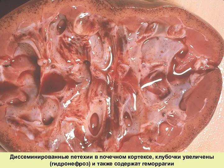 Диссеминированные петехии в почечном кортексе, клубочки увеличены (гидронефроз) и также содержат геморрагии