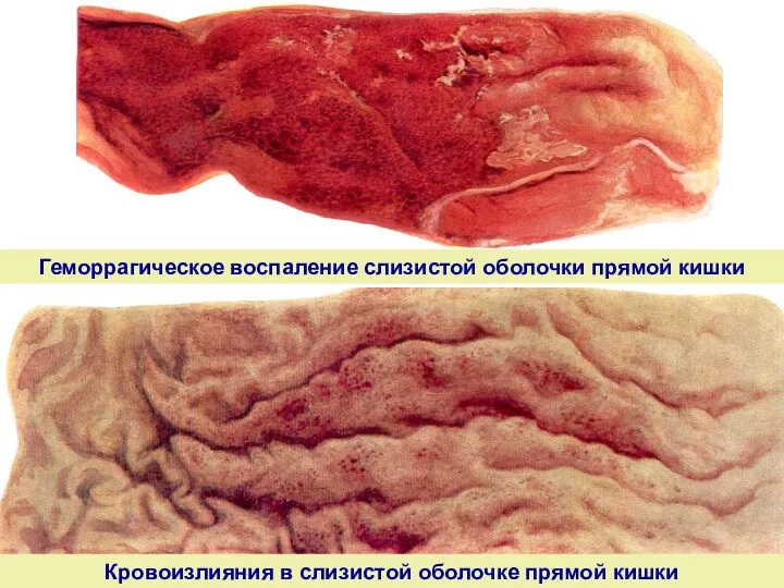 Геморрагическое воспаление слизистой оболочки прямой кишки Кровоизлияния в слизистой оболочке прямой кишки