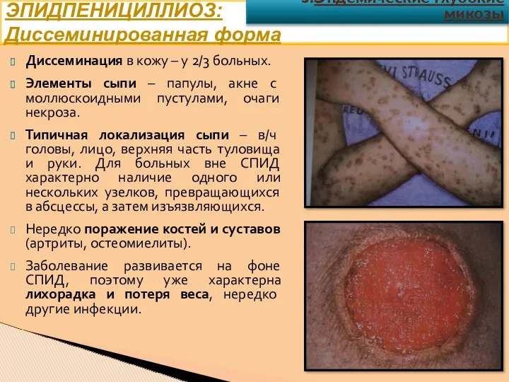 Диссеминация в кожу – у 2/3 больных. Элементы сыпи –