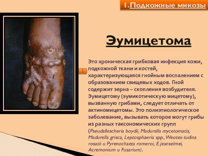 Эумицетома Это хроническая грибковая инфекция кожи, подкожной ткани и костей, характеризующаяся гнойным воспалением