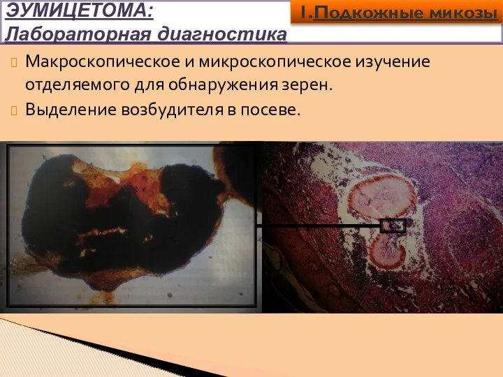 ЭУМИЦЕТОМА: Лабораторная диагностика Макроскопическое и микроскопическое изучение отделяемого для обнаружения