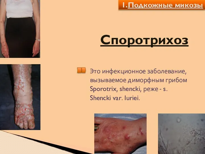 Споротрихоз Это инфекционное заболевание, вызываемое диморфным грибом Sporotrix, shencki, реже - s. Shencki